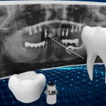 روش‌ های دیجیتال و ارتقا علم ایمپلنتولوژی